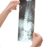 Scoliosis related image